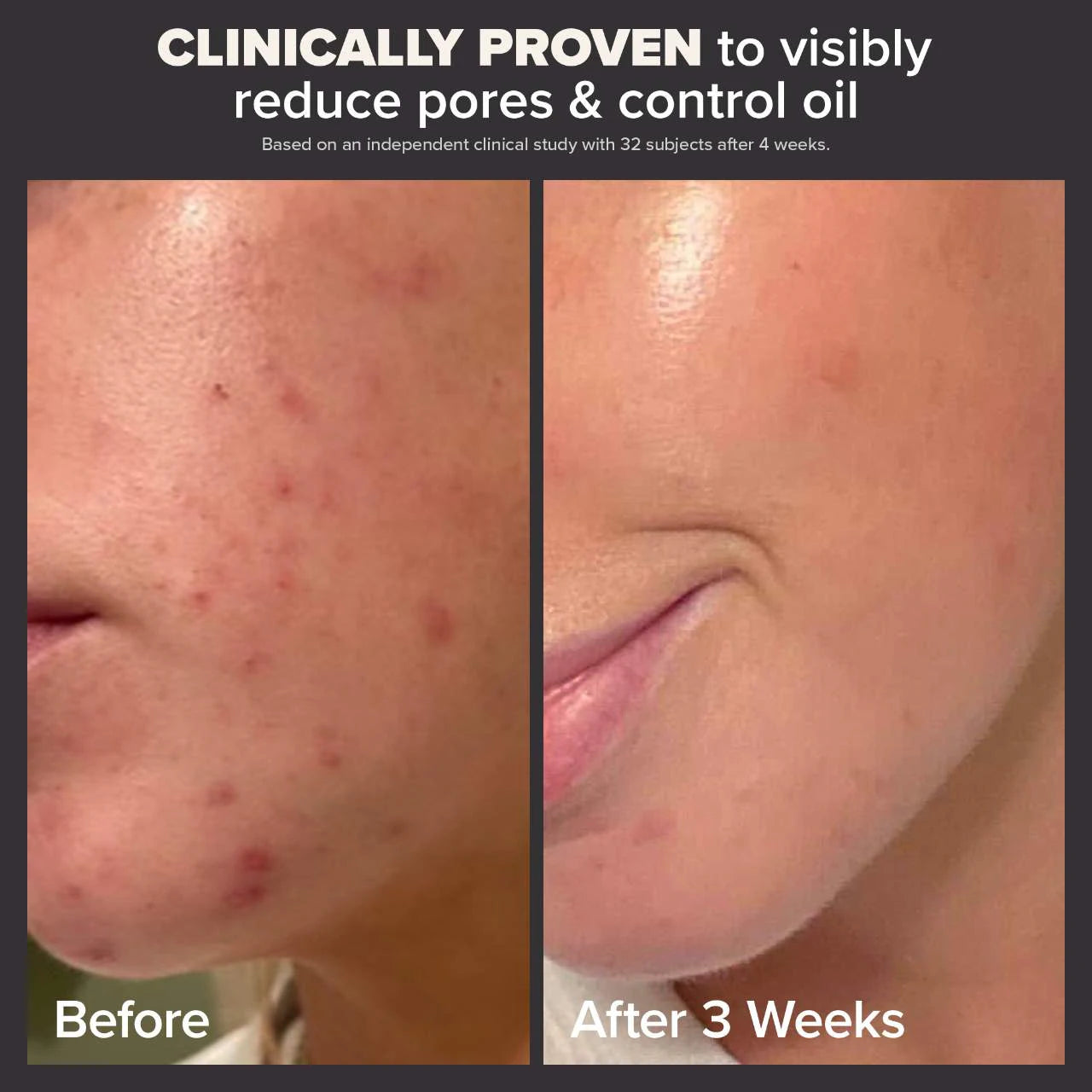 PAULA'S CHOICE SKIN PERFECTING 2% BHA LIQUID EXFOLIANT
